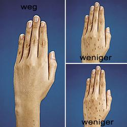 Altersflecken-weg, Roll-On 10 ml