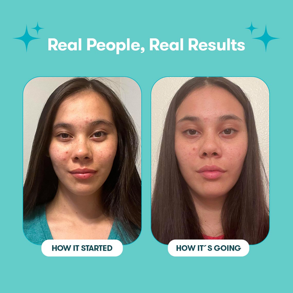 Proactiv Gentle 60 Day Routine 240 ml + 30 Zits Happen Patches