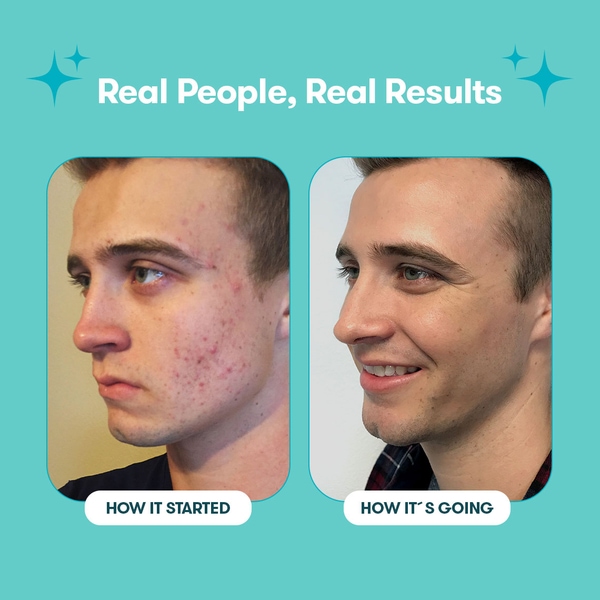 Proactiv Solution 30 jours de routine 150 ml + 30 patchs Zits Happen