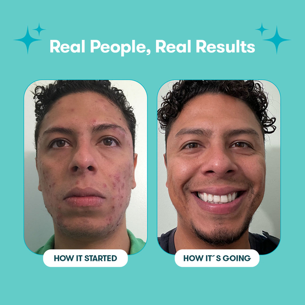 Proactiv Gentle 60 Day Routine 240 ml + 30 Zits Happen Patches