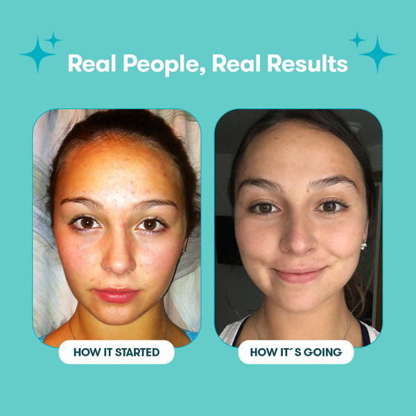 Proactiv Solution 30 jours de routine 150 ml + 30 patchs Zits Happen